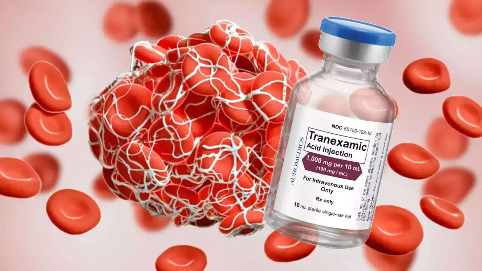 Prophylactic parenteral tranexamic acid significantly reduces blood loss during and after caesarean section,  reveals study