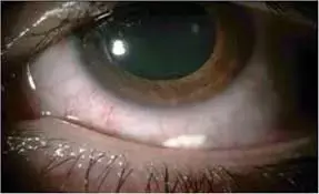 Subconjunctival triamcinolone acetonide injection useful prophylactic therapy for pseudophakic macular edema: Study