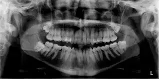 Nonsurgical root canal treatment or retreatment of teeth with large apical periodontitis lesions tied to favourable outcomes: Study