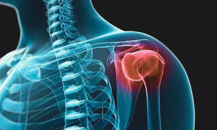 Positive Outcomes for Rotator Cuff Healing with Bioinductive Collagen Implant, but Adhesive Capsulitis Raises Concerns: Study