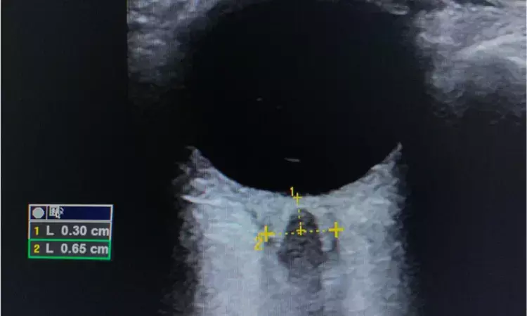 Optic nerve sheath diameter not linked with hypertensive disorders of pregnancy, reveals research