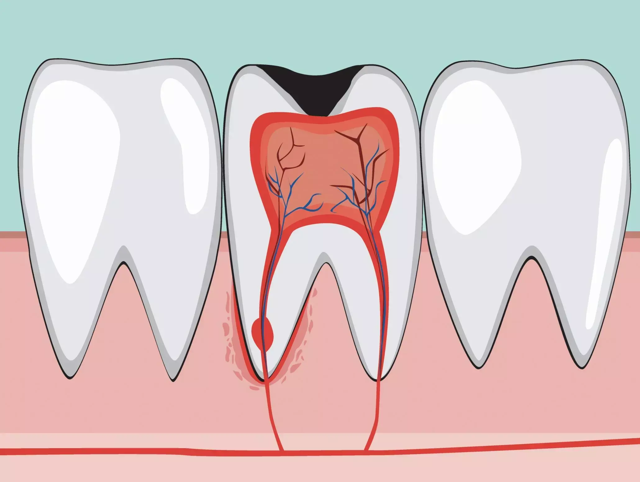 Pulpotomy viable alternative to Root Canal Treatment in Mature Permanent Teeth, finds study