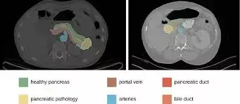 Hyperlipasemia immediately after pancreatic resections may predict pancreatic fistula, reveals study