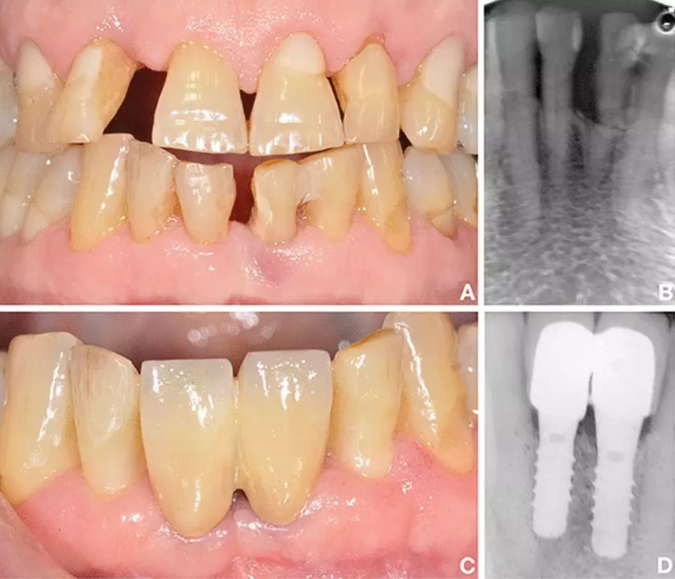 Outcomes of Immediate implant placement in damaged extraction sockets comparable to conventional implant placement finds study