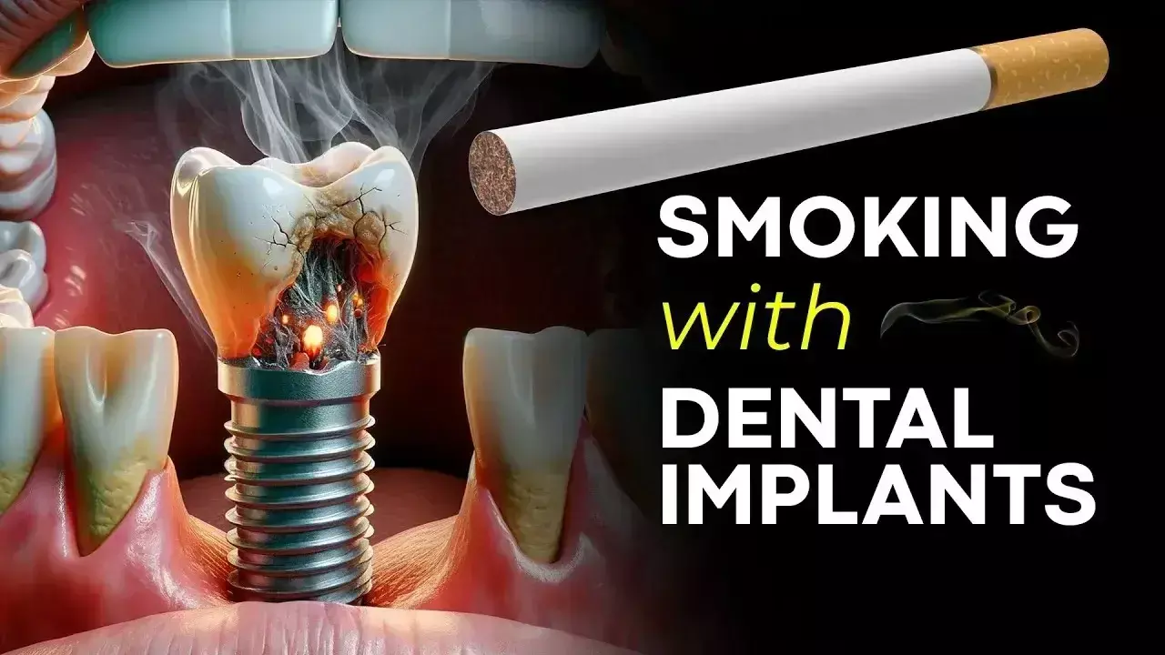 Smoking associated with early dental implant failure, reports research