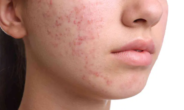 FDA approves Laser system for long term treatment of inflammatory acne