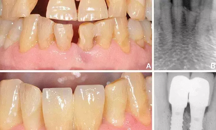 Outcomes of Immediate implant placement in damaged extraction sockets comparable to conventional implant placement finds study