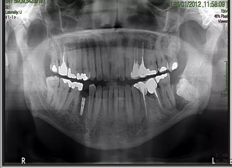 Long term outcomes of mandibular coronectomy satisfactory when enamel is completely removed, suggests study