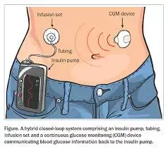 Hybrid closed-loop insulin therapy prevents low night-time blood glucose levels among breastfeeding mothers with type 1 diabetes: Study