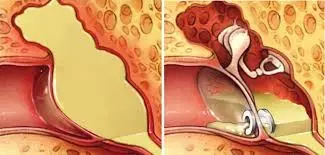 Adenoidectomy combied  with tympanostomy tube  insertion may significantly reduce repeat procedures and oral antibiotic use in kids: JAMA