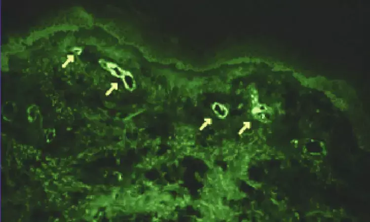 Scoping Review Highlights Diagnostic Value of Direct Immunofluorescence in Cutaneous Vasculitis