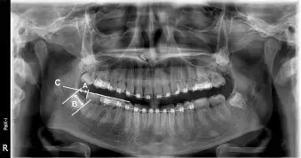 Developmental disability patients not at higher infection risk after third molar extractions, suggests study