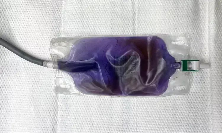 Elderly Patient Develops Rare Purple Urine Bag Syndrome, Raising Awareness of Catheter-Related Risks: Case Report