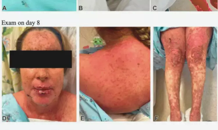 COVID-19 Linked to Deadly Relapsing Toxic Epidermal Necrolysis: A Case Report