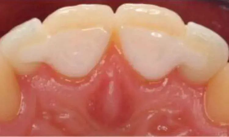 Direct composite bests zirconia resin-bonded fixed dental prostheses for  single missing anterior tooth:Study