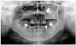 AI-based solutions accurately and reliably evaluate root canal filling, claims research