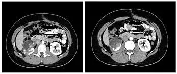 Among pediatric renal tumor patients, Robot-assisted resection feasible, safe with less surgical trauma: Study