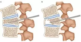 Prophylactic infusion of norepinephrine may prevent hypotension during vertebroplasty, reports research