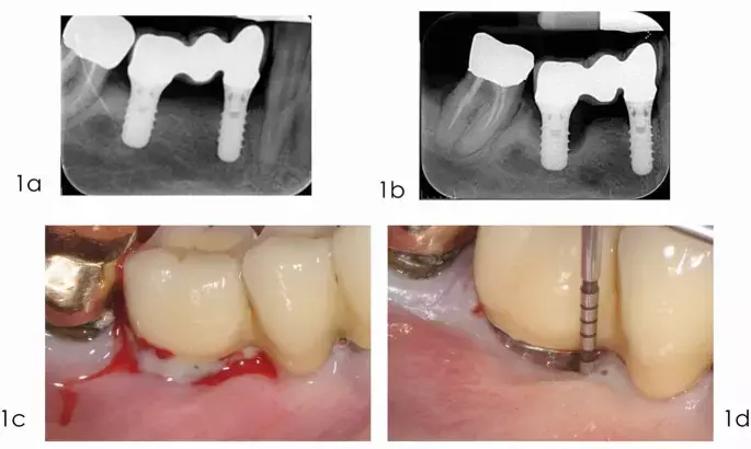 Submerged reconstructive approach significantly enhances clinical outcomes of surgical treatment of periimplantitis suggests study