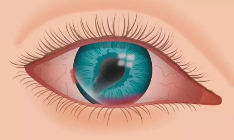 Study Reveals Amniotic Membrane Grafting Effective for Moderate Ocular Burns, Limited in Severe Cases