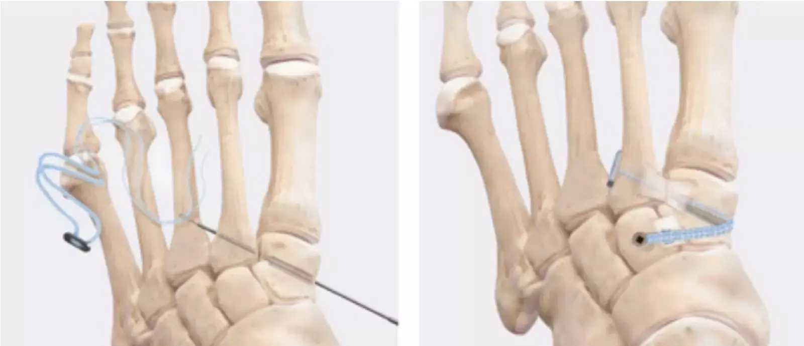 Arthrex Internal Brace viable option for open reduction and internal fixation of Lisfranc ligamentous injuries: Study