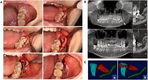 Compared to surgical removal of mandibular third molars, Coronectomy significantly impacted postoperative oral health related QoL: Study