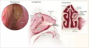 Chronic rhinosinusitis with and without nasal polyps closely correlated with asthma, reveals study