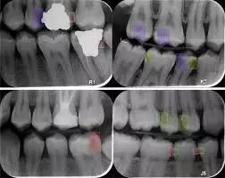 AI-assisted  bitewing radiographs have high accuracy for caries detection, reveals research