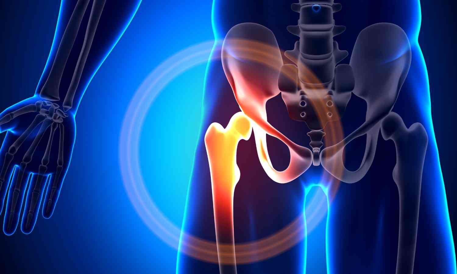 Artificial intelligence predicts success of hip operations, finds research