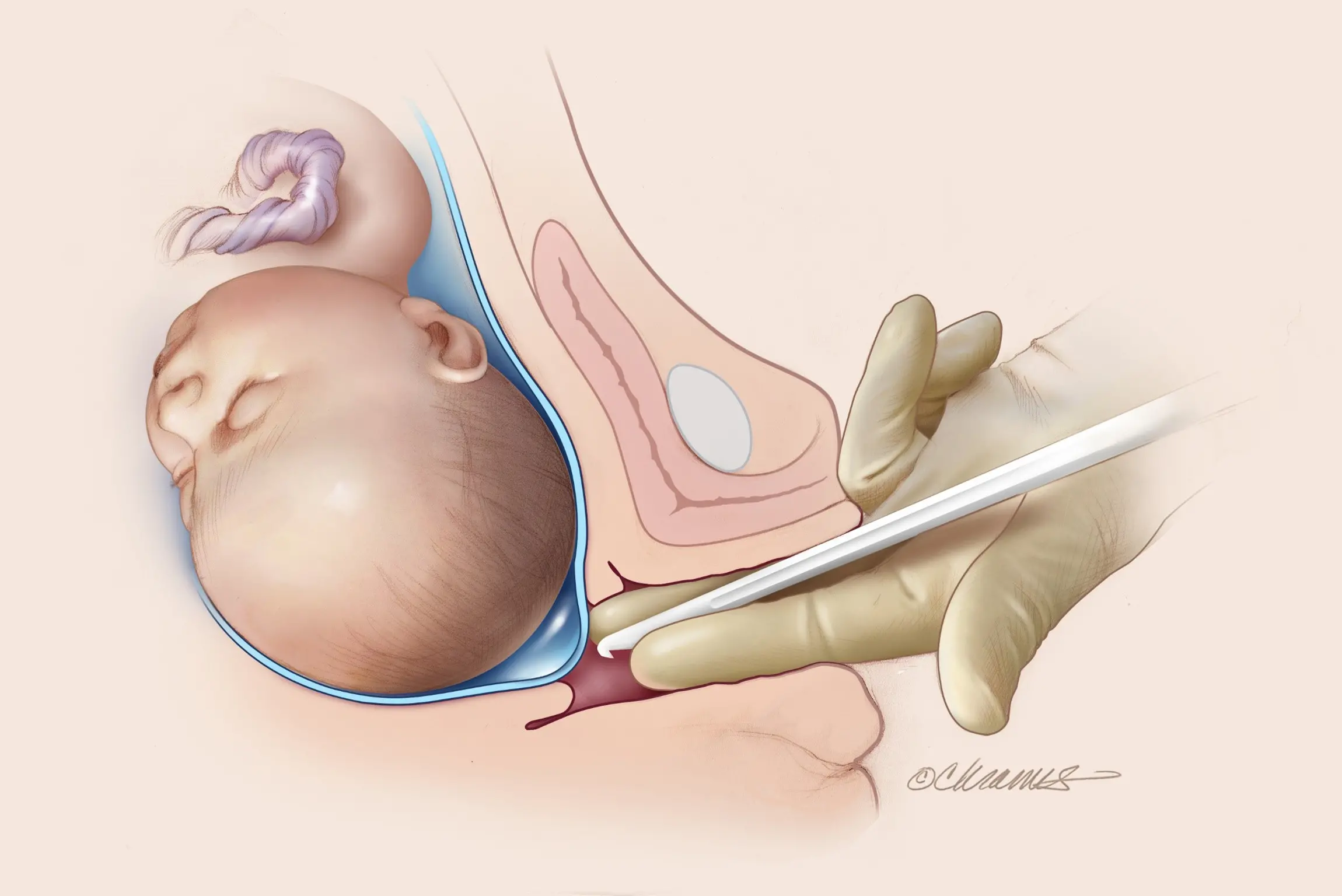 Calcium and oxytocin combo Better for inducing labor in term women with premature rupture of membranes: Study