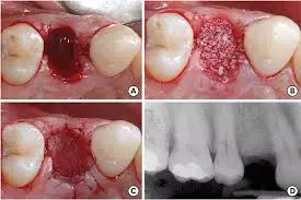 Operating microscope use during alveolar ridge preservation tied to improved healing: Study