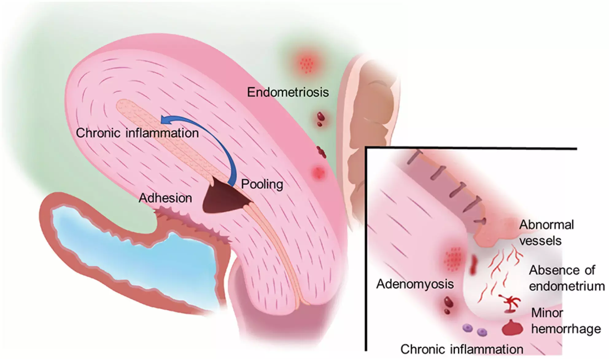 Chronic Endometritis associated with Caesarean Scar Diverticulum  leading to prolonged menstruation and anemia: Study