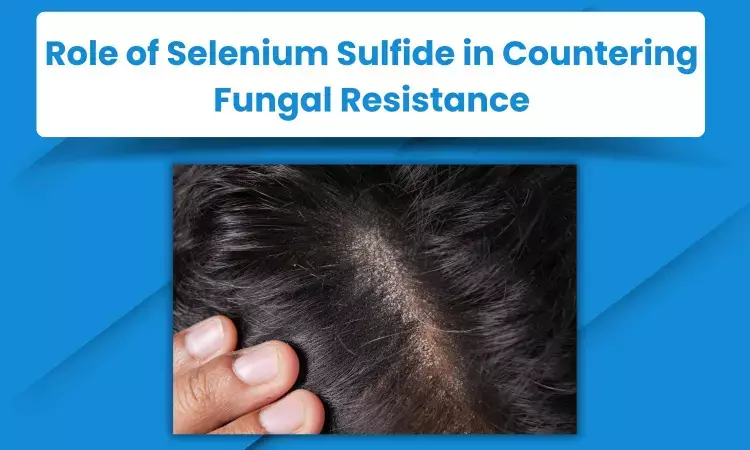 Combatting Anti-fungal Resistance: Selenium Sulfide as a Promising Solution in Tackling Tinea Versicolor and Seborrheic Dermatitis