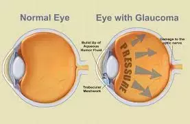 SGLT2 inhibitors linked to lower glaucoma risk, reveals research