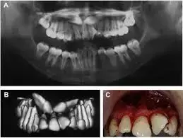 AI-based model may help in early detection of ectopic tooth eruptions, suggests study