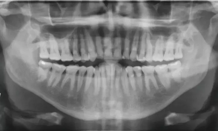 AI Enhances Carotid Plaque Detection in Dental Imaging, Paving Way for Early Atherosclerosis Diagnosis: Study