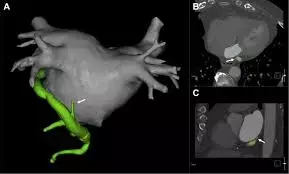 Pulmonary vein isolation with Ethanol infusion of vein of Marshall bests pulmonary vein isolation for treatment of persistent AF:JAMA