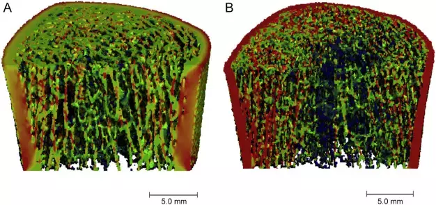 Bone Mineral Density Declines More Rapidly in Adults With Cystic Fibrosis, finds study