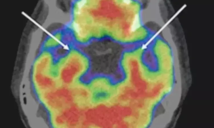 Chronic stress-related amygdala metabolic activity and lymph node metastasis in endometrial cancer