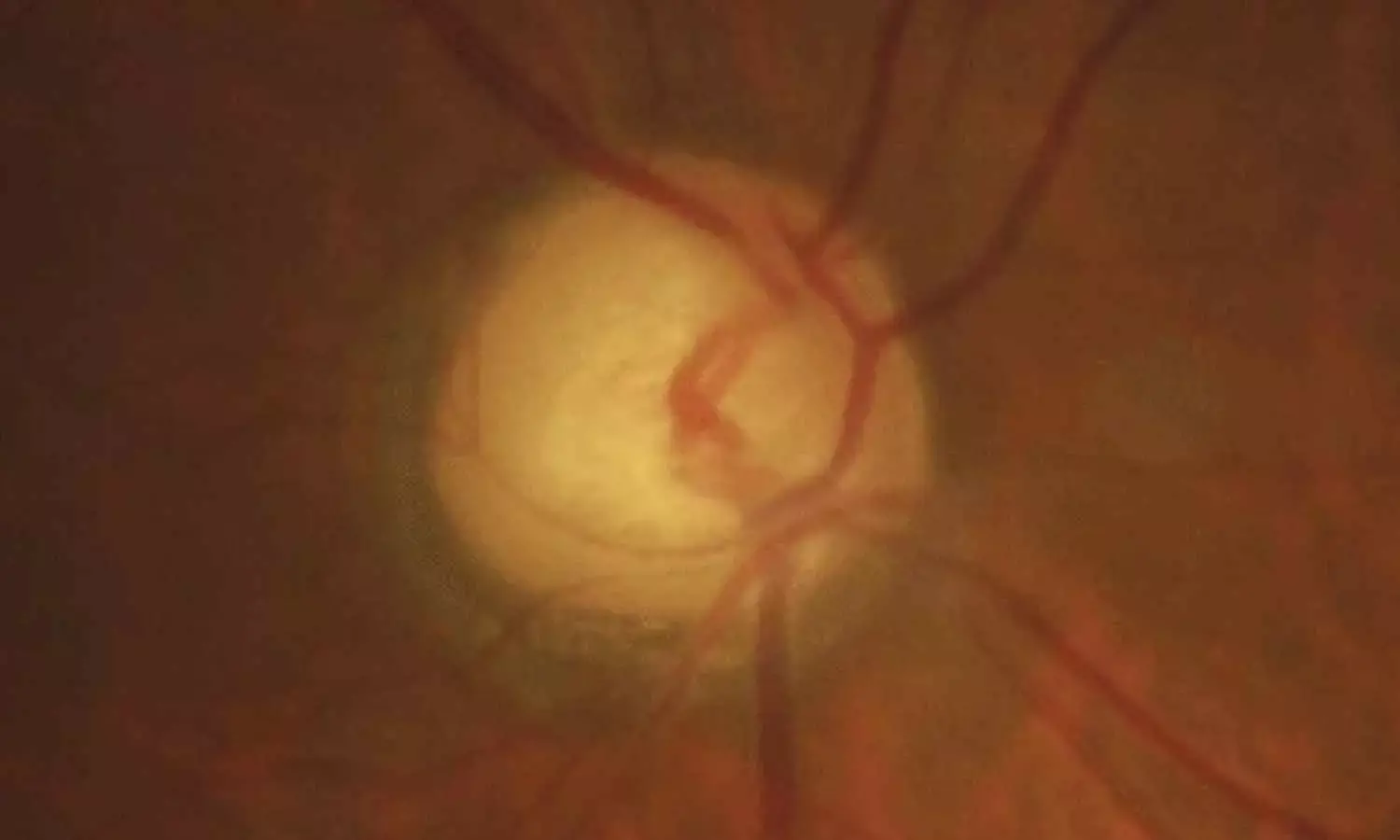 Transscleral Cyclophotocoagulation effectively lowers IOP among glaucoma patients:Study