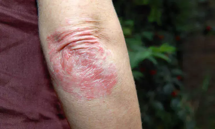 Deucravacitinib Found to Be Safe and Effective for Psoriasis Over 3 Years: JAMA