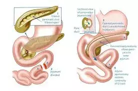 Early surgery bests endoscopy-first approach in painful chronic pancreatitis with dilated pancreatic duct: JAMA