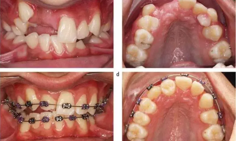 Autotransplantation of third molars with fully formed roots promising solution for replacing missing teeth, finds study