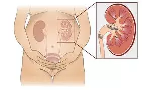 MR study doesnt support causal association between serum vitamin D levels and urolithiasis