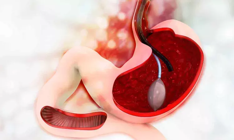 An inflatable gastric balloon could help people lose weight,  reveals research