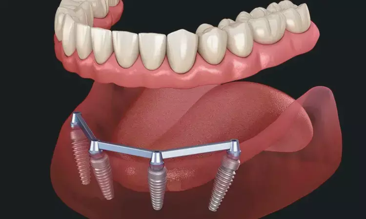 Reduced-Diameter Implants Supporting Overdentures