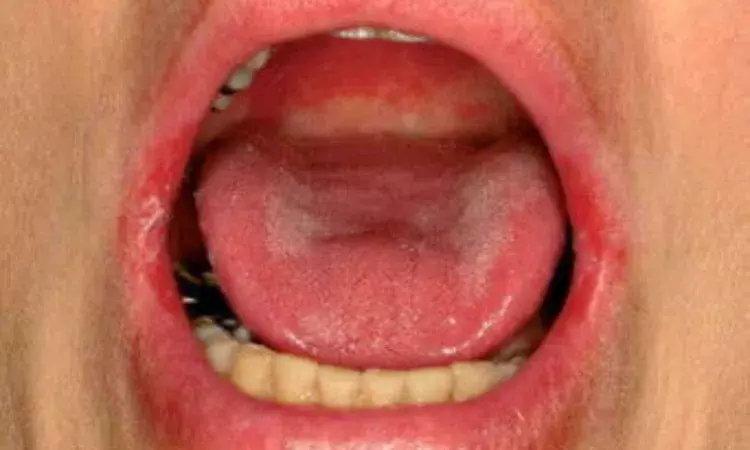 Persisting oral infection linked to posttransplant infectious complications, suggests study