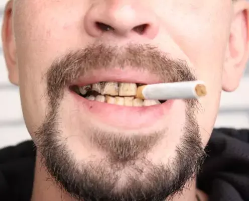 Frequent recreational cannabis use associated with caries and tooth loss, suggests study