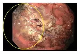 Sodium polystyrene sulfonate associated with repeated gastric ulcers in hemodialysis patients: Case report