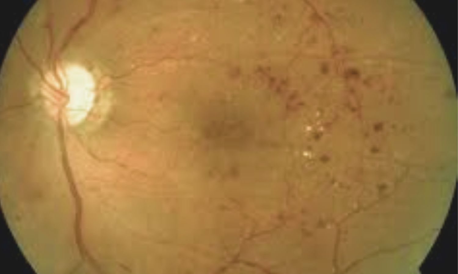 Real-World Retinal Treatment Patterns Reflect Evidence-Based Practice ...